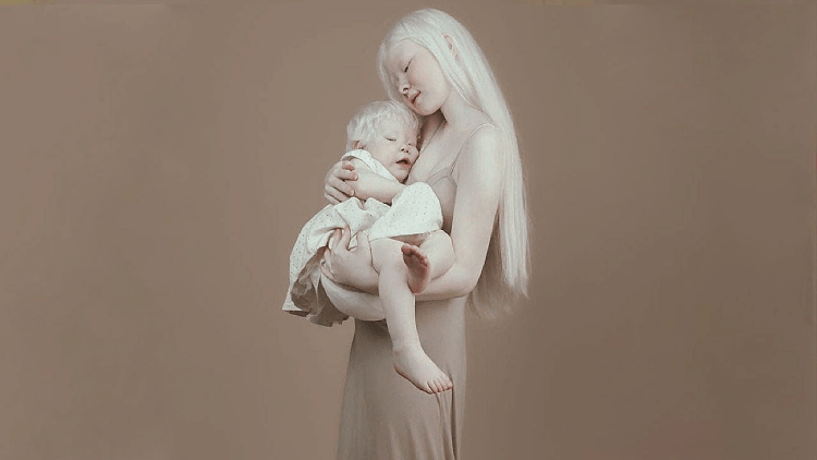 Мама альбинос