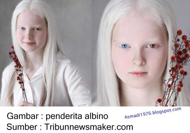 Амина Арсакова альбинизм гетерохромия