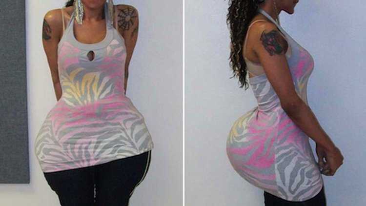 Девушки с имплантами в ягодицах