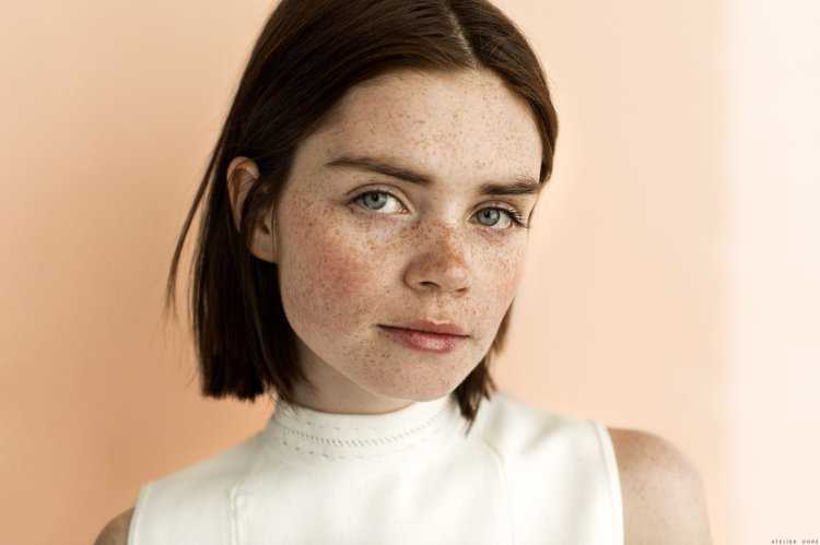 Веснушки у людей с темными волосами