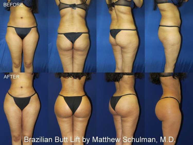 Типы женских ягодиц