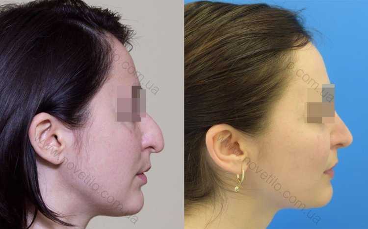 Орлиный нос инцел