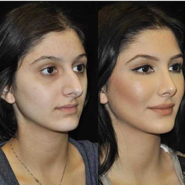 Девушки до и после пластики носа