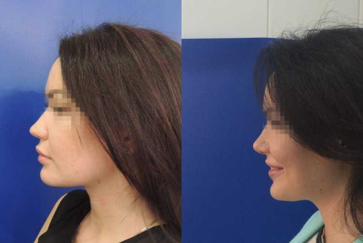 Редукционная ринопластика