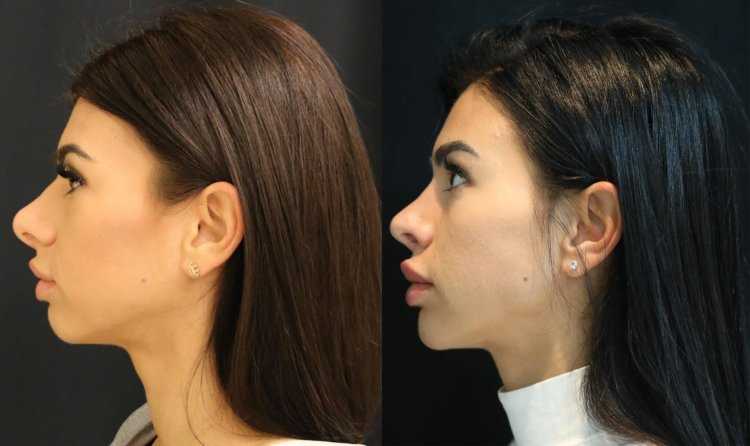 Ринопластика Новосибирск