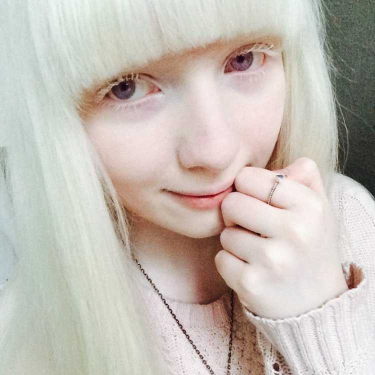 Анастасия Пяткова альбинос