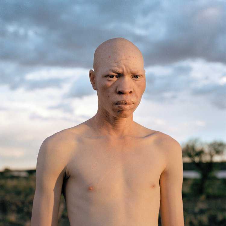 Альбинос негроидной расы