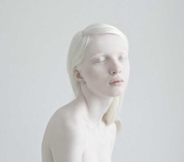 Rosie Crawford альбинос