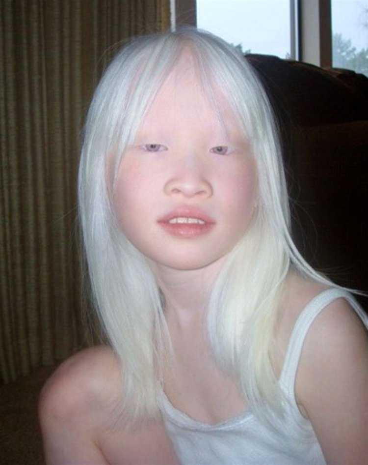 Европеоид альбинос