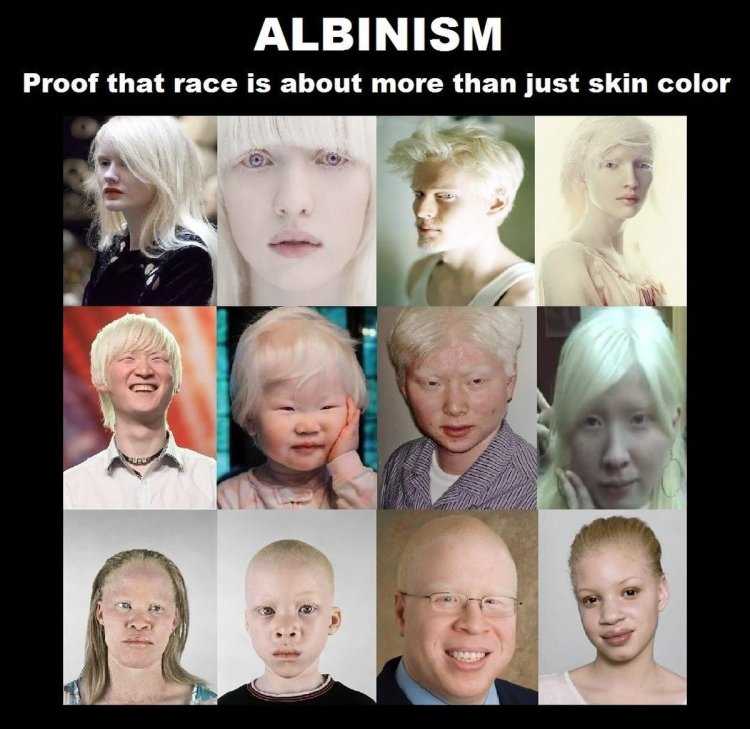 Хромосомные болезни альбинизм