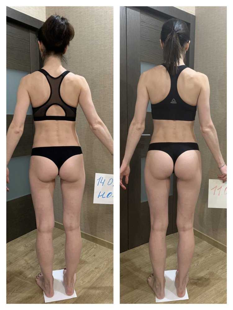 Асимметрия ягодиц