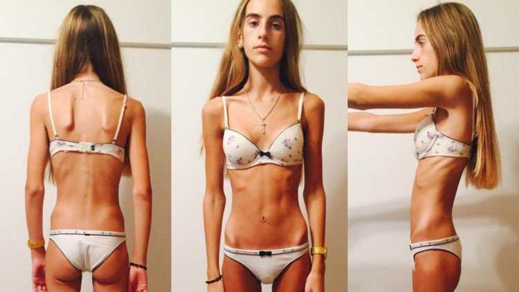 Ксения Князева Анорексичка