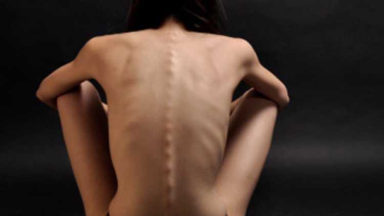 Дисморфоманическая анорексия