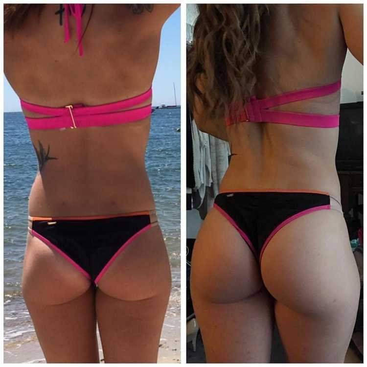 Несимметричные ягодицы