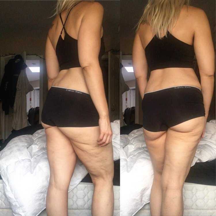 Целлюлит у девушек