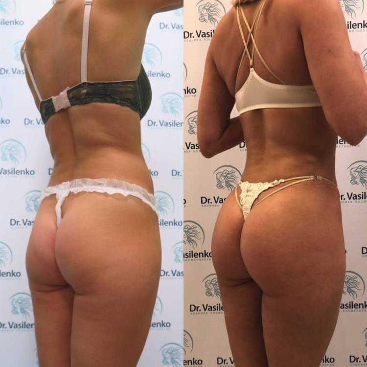 Липофилинг ягодиц