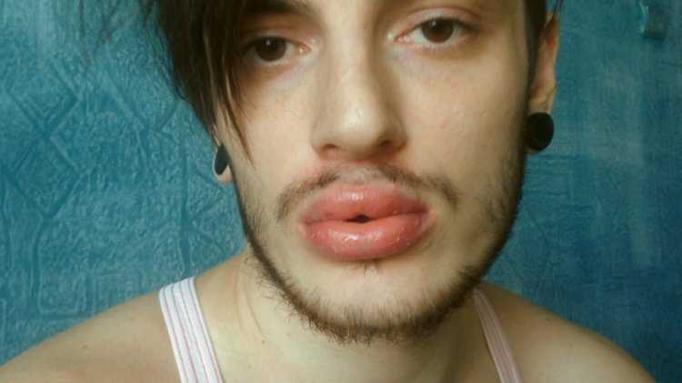 Мальчик с накаченными губами