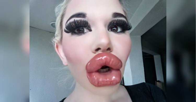 Андреа Эмилова силиконовые губы