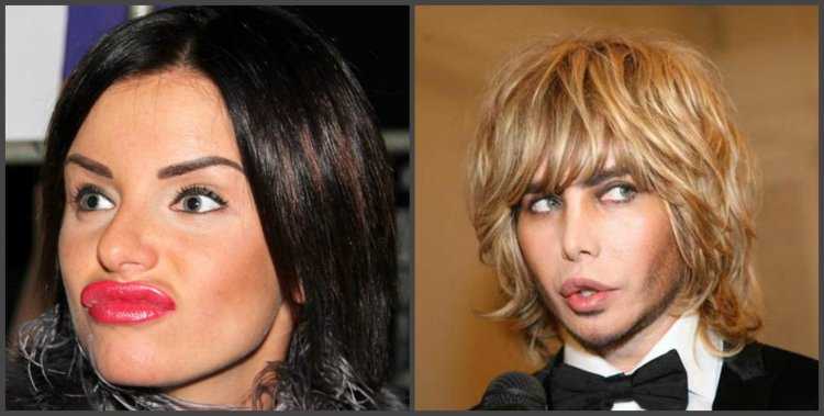 Юлия Волкова после пластической операции