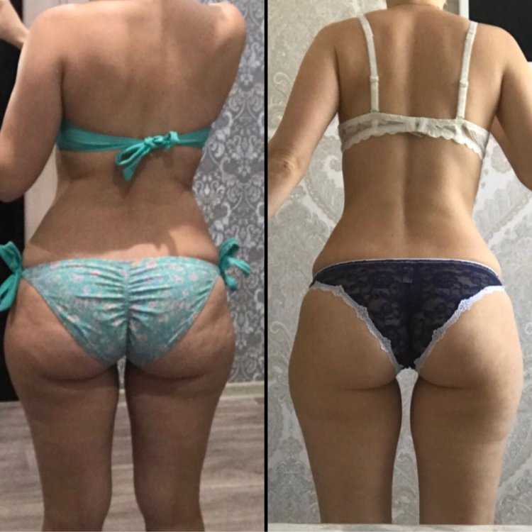 Целлюлитные ноги и ягодицы