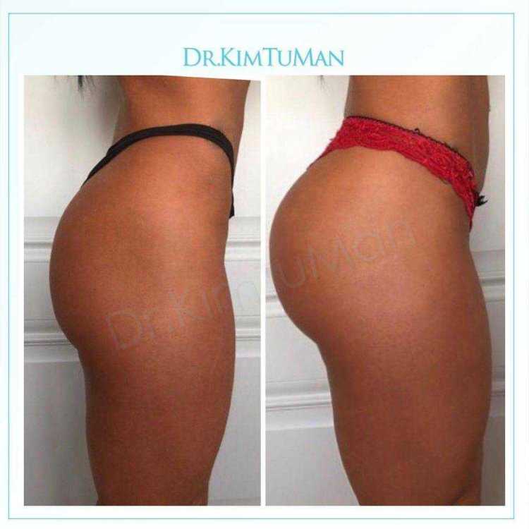 Глютеопластика липофилинг