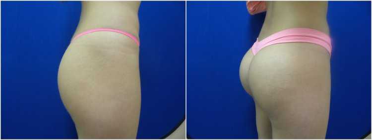 Силиконовые ягодицы до и после