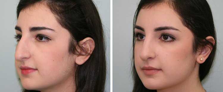 Иса Абдулазизович ринопластика