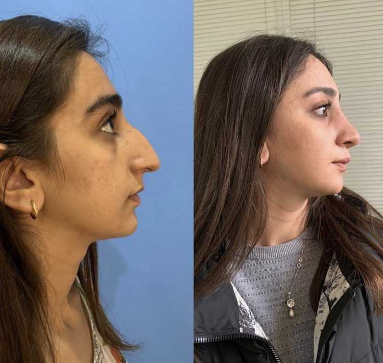 Ринопластика горбинка