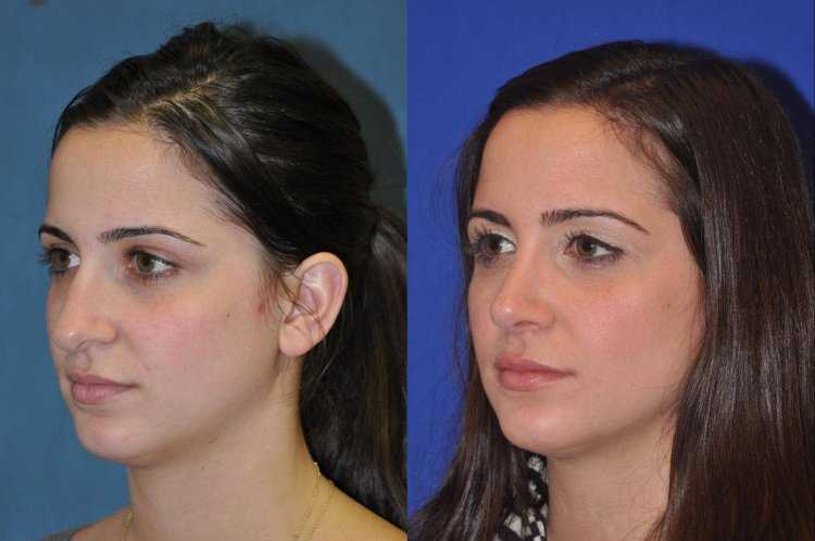 Ринопластика носа