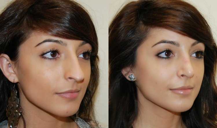 Ринопластика армянки