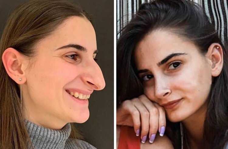 Ахмед Дилбер ринопластика