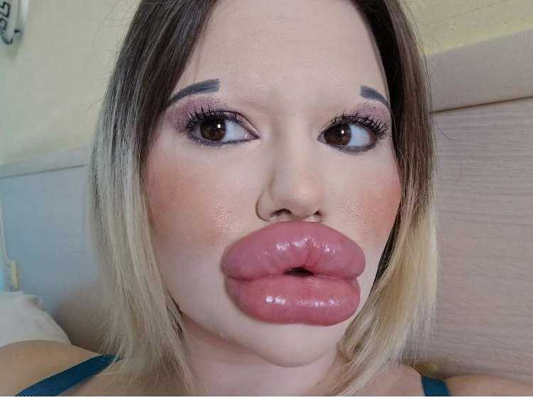Девушка с самыми большими губами мире