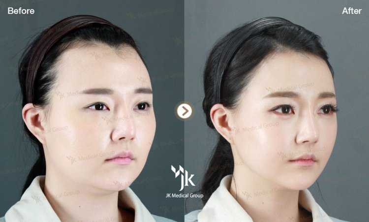 Корейский нос