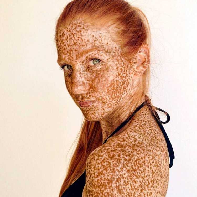 Веснушки на ягодицах