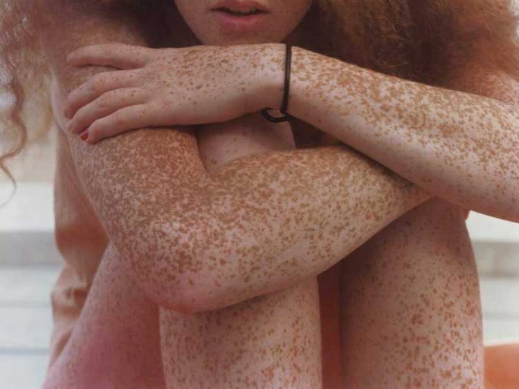 Веснушки на ногах у девушки