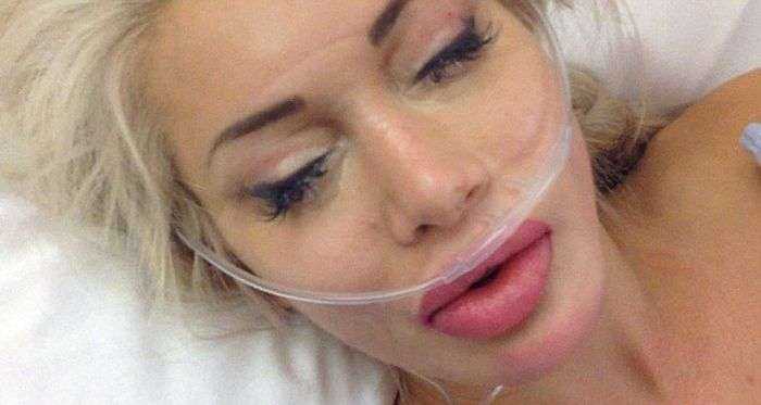 Очередная любительница пластических операций